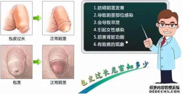 【昌吉佳美男科医院】割割割包皮啦!